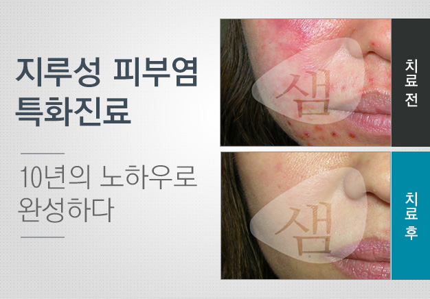 지루성피부염의 특화치료