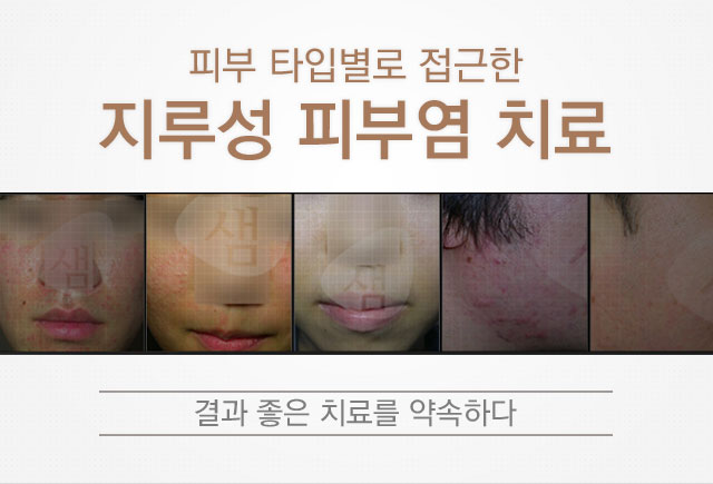 지루성피부염의 치료